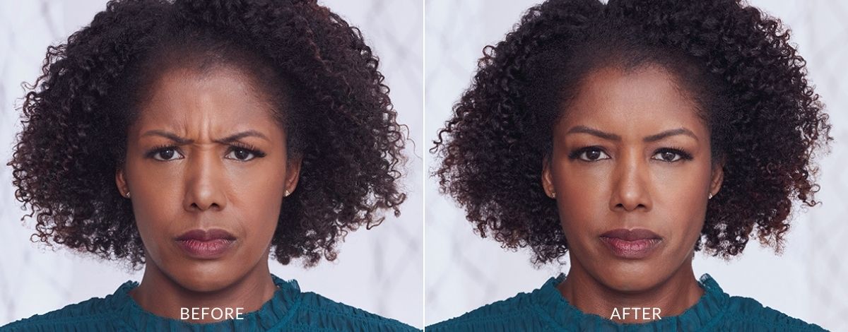 Woman showing before and after Botox treatment results.