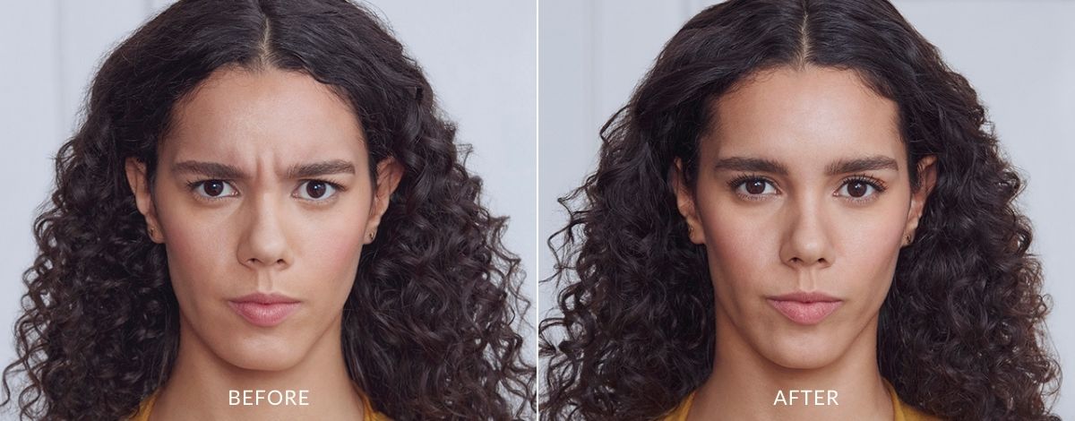 Woman showing before and after Botox treatment results.