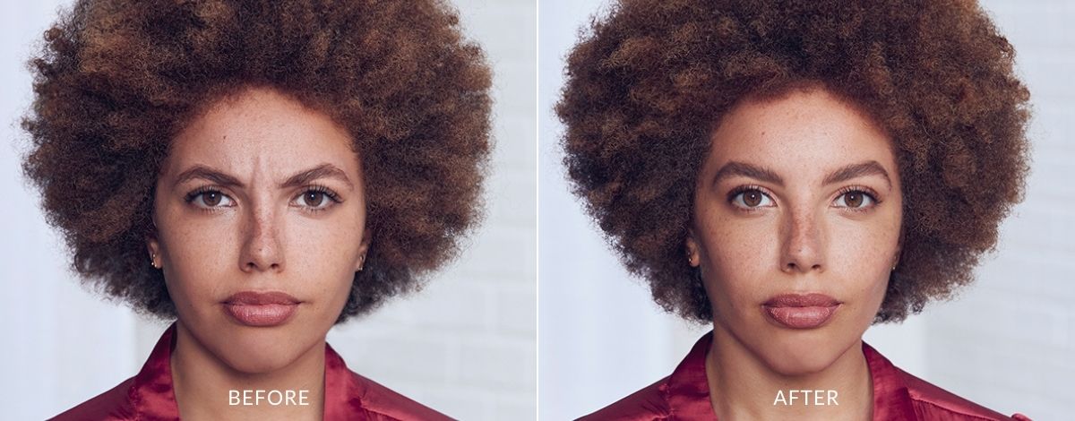 Woman showing before and after Botox treatment results.