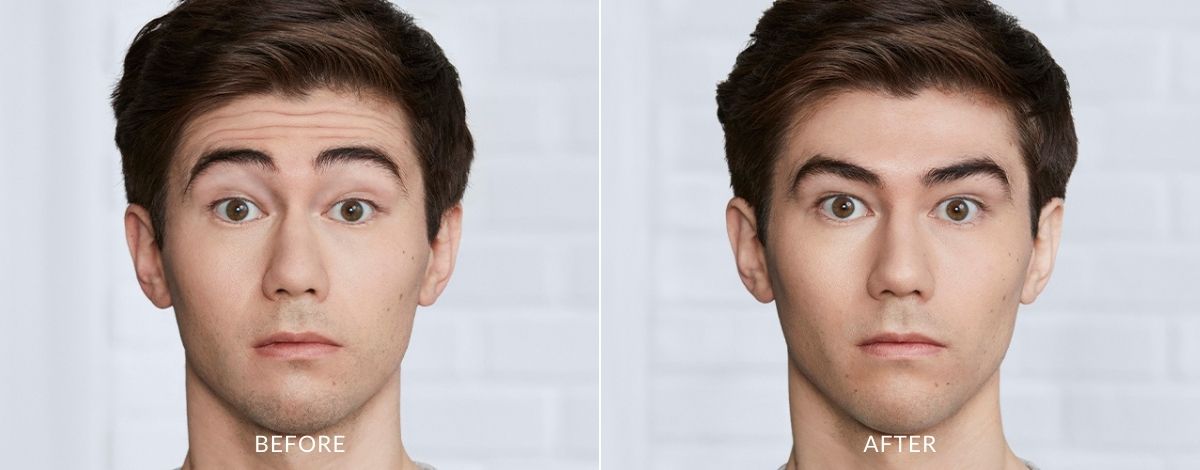 Man showing before and after Botox treatment results.
