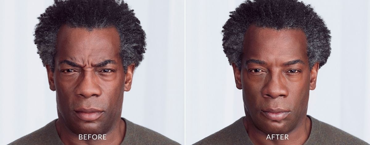 Man showing before and after Botox treatment results.
