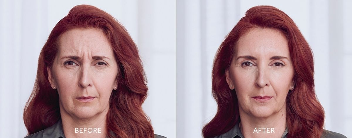 Woman showing before and after Botox treatment results.