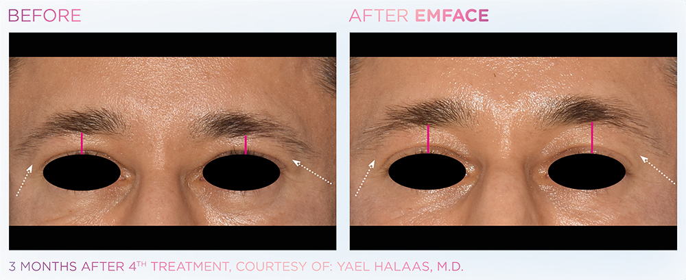 Emface_browlift_before_and_after (2)