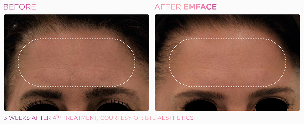 Forehead before and after emface.