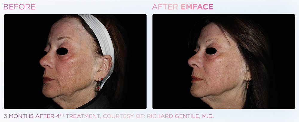 Full face before and after Emface.