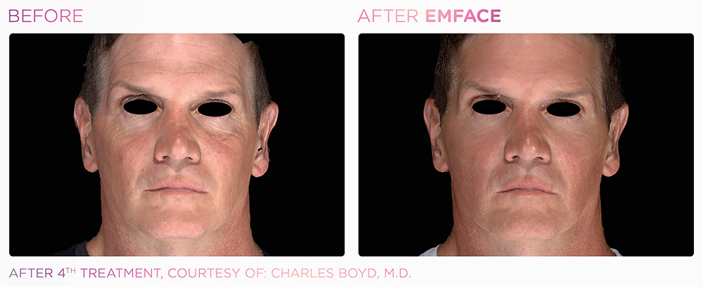 Full face before and after Emface.