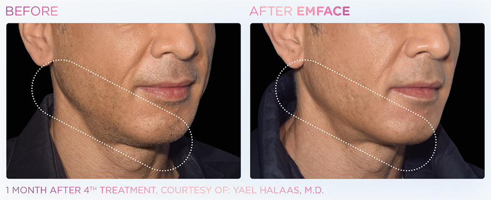Jawline before and after Emface.