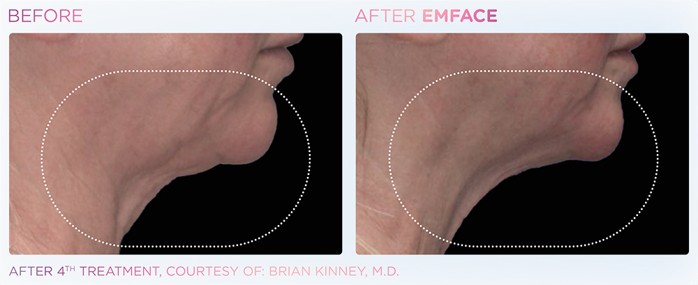 Lifted neck before and after emface.