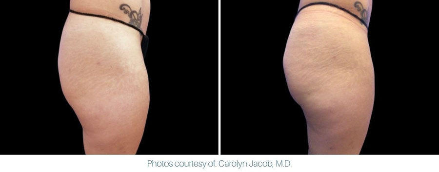 Buttocks showing before and after results with Emsculpt NEO treatment at North Shore Medical Wellness in NY.