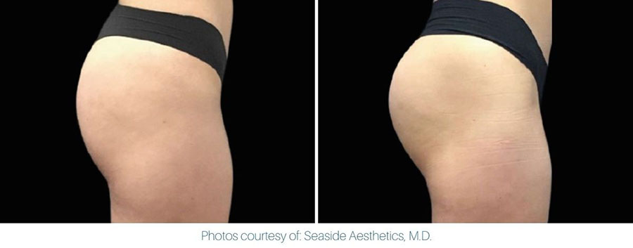 Buttocks showing before and after results with Emsculpt NEO treatment at North Shore Medical Wellness in NY.