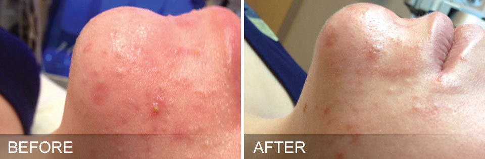 An image of before and after Hydrafacial treatment.