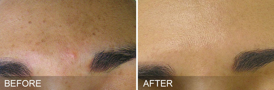 An image of before and after Hydrafacial treatment.