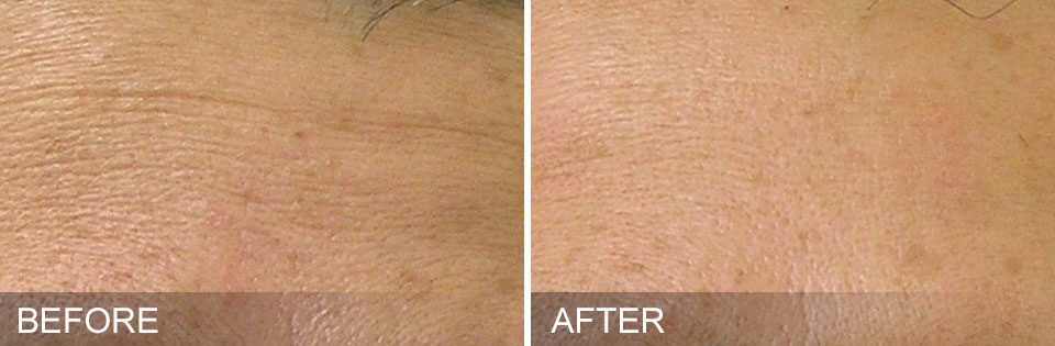 An image of before and after Hydrafacial treatment.