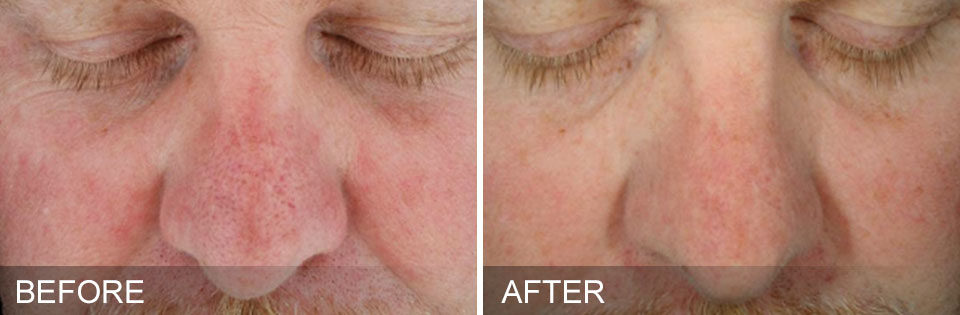 An image of before and after Hydrafacial treatment.