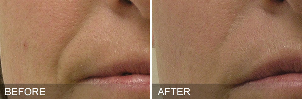 An image of before and after Hydrafacial treatment.