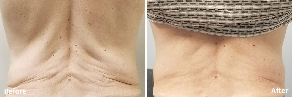 Morpheus 8 before and after treatment on woman's back.