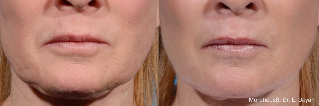 Morpheus 8 before and after treatment on woman's face.