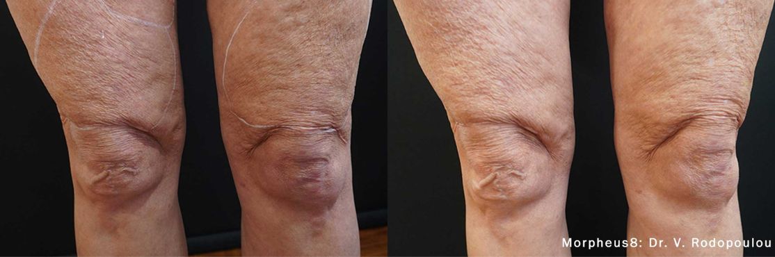 Morpheus 8 before and after on woman's legs.