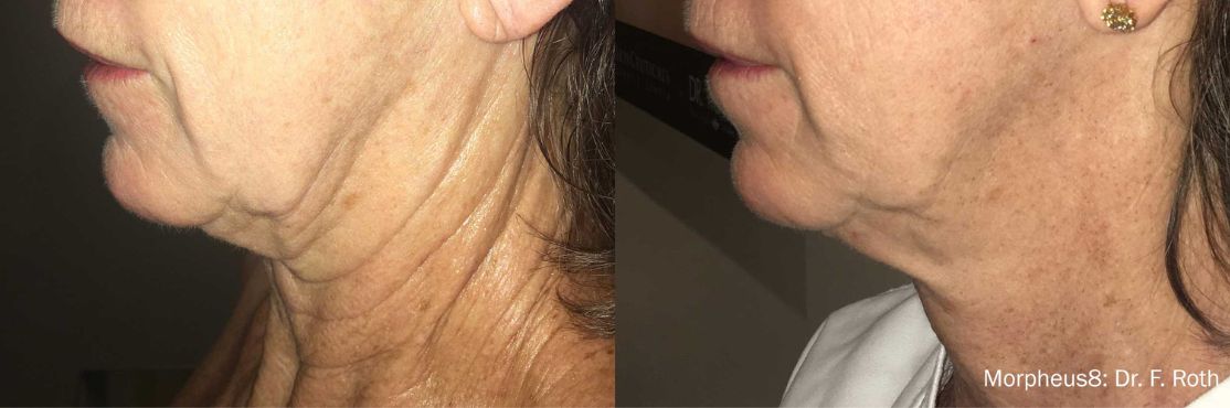 Morpheus 8 before and after treatment on woman's neck and chin area.