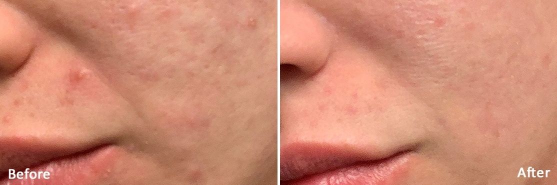 Morpheus 8 before and after treatment on woman's face.