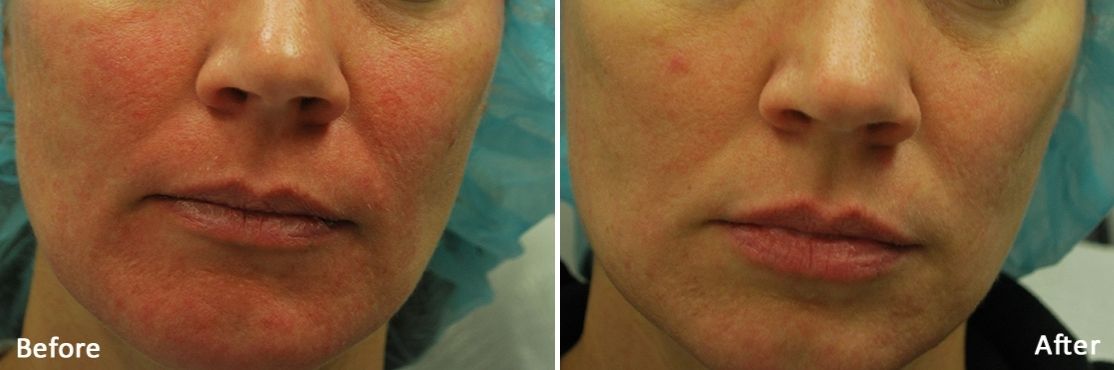 Morpheus 8 before and after treatment on woman's face.