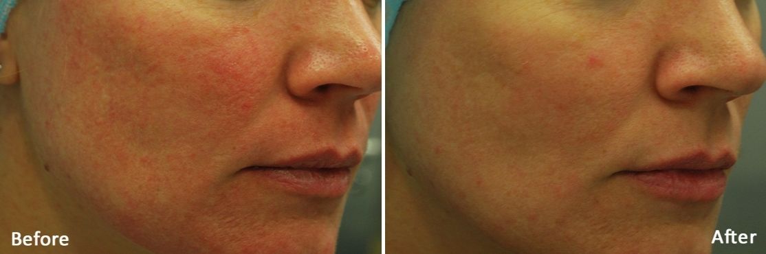 Morpheus 8 before and after treatment on woman's cheeks.