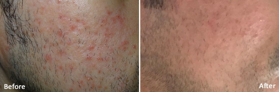 Morpheus 8 before and after treatment on a man's cheek.