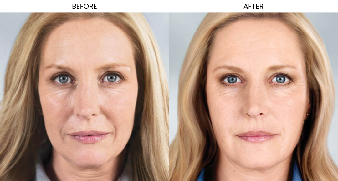 Sculptra Before And After-1
