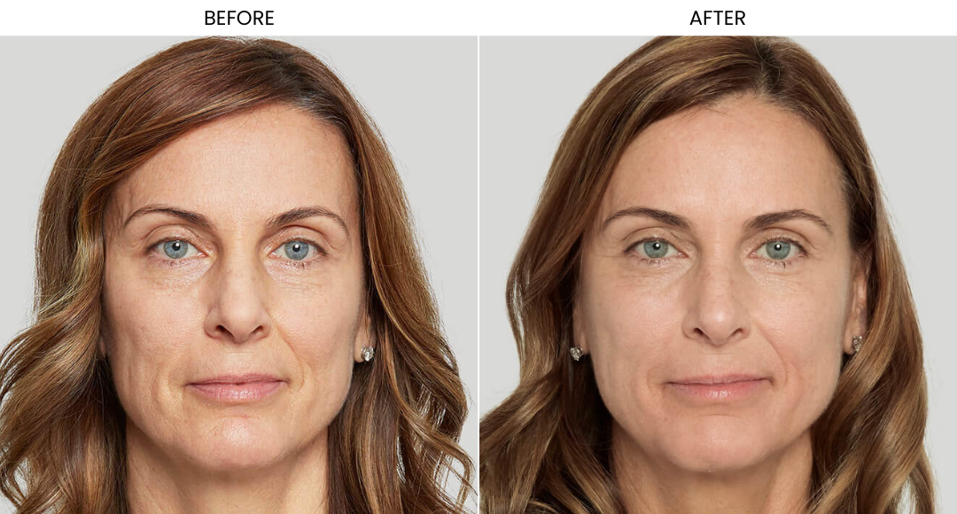Sculptra Before And After-2