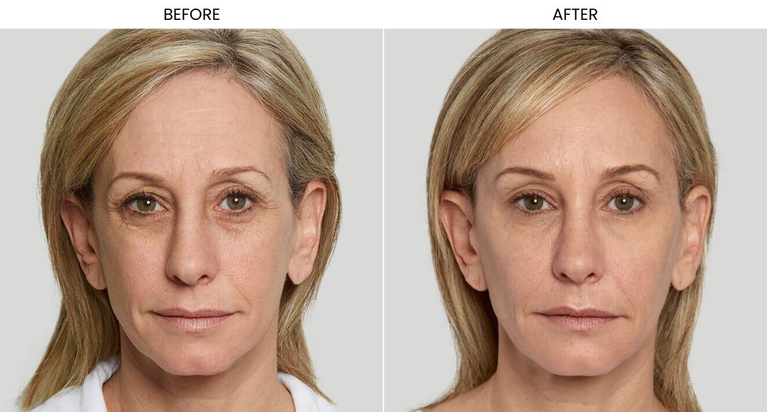 Sculptra Before And After-3