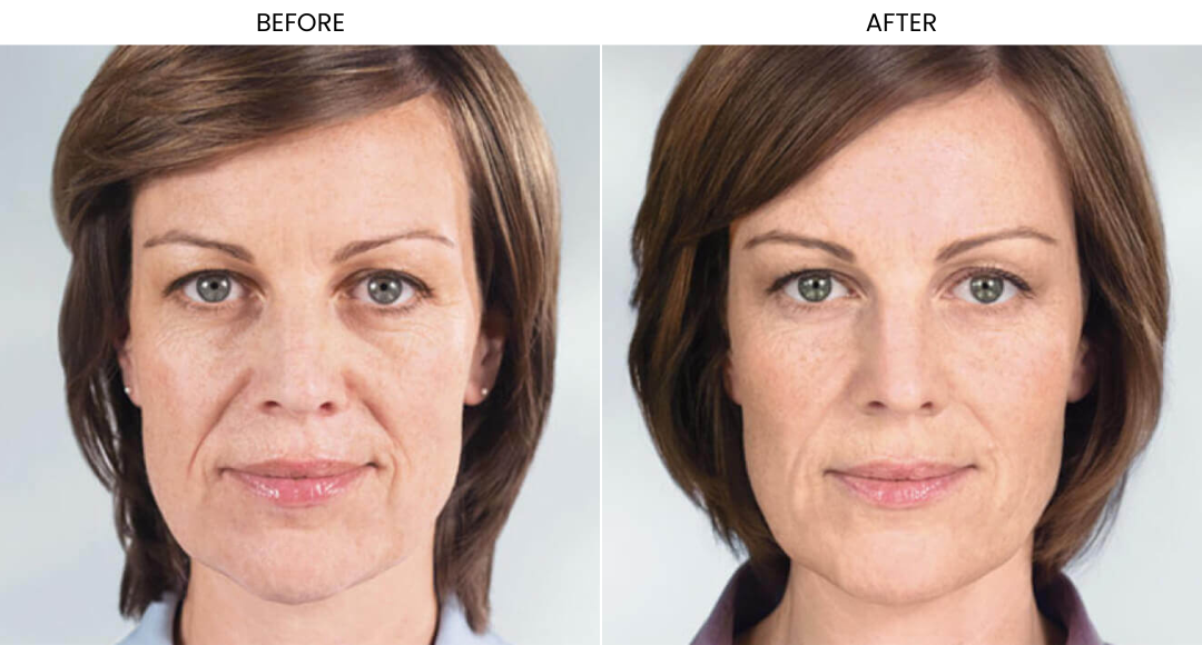 Sculptra Before And After-4